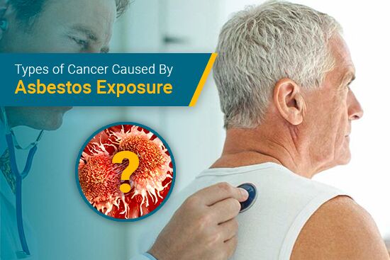 Types of Cancer Caused by Asbestos Exposure