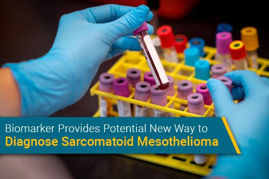 Sarcomatoid Mesothelioma