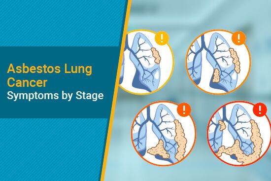 Symptoms of asbestos lung cancer in each stage