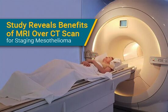 Study Reveals Benefits of MRI Over CT Scan for Staging Mesothelioma