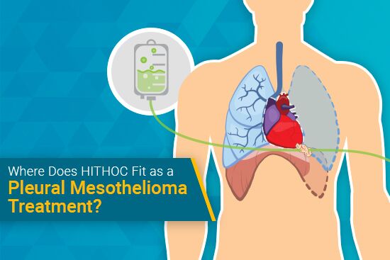 HITHOC as a Pleural Mesothelioma Treatment